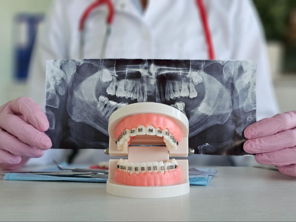 Why Retainer Wear Is More Important Than Braces