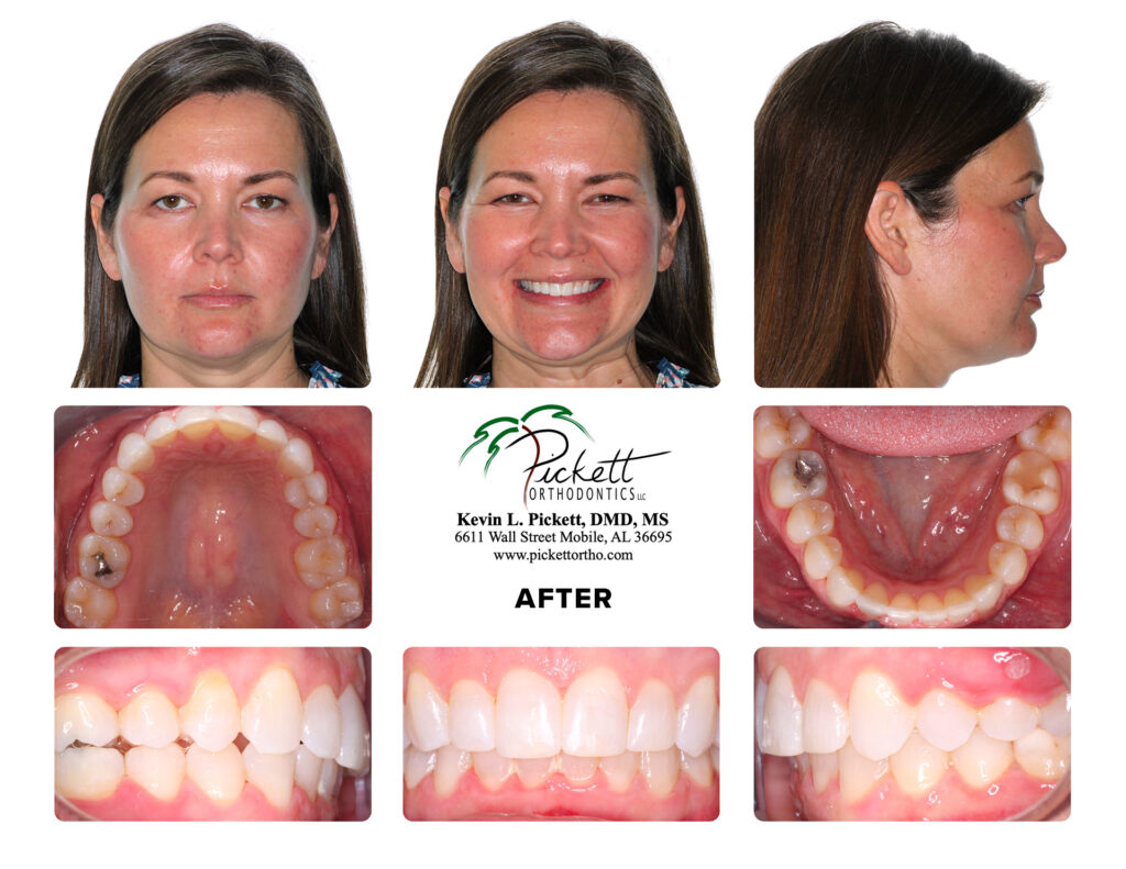 How Personalizing Your Smile Line Makes a World of Difference